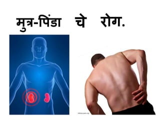 मुत्र-वपडंा चेरोग. 
 