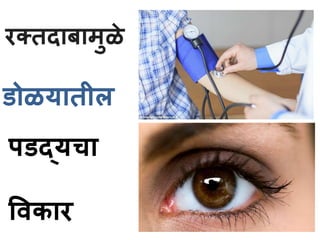 रक्तदाबामुळे 
डोळयातील 
पडद्यचा 
ववकार 
 