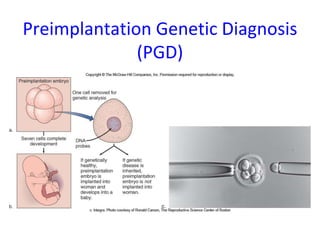 Preimplantation Genetic Diagnosis
(PGD)
 