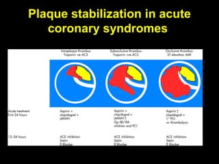 Plaque stabilization in acute
coronary syndromes
 