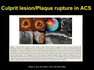 Culprit lesion/Plaque rupture in ACS
Okaki Y et al. Eur Heart J 2011;32:2814-2823
 