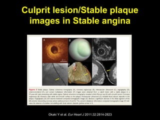 Culprit lesion/Stable plaque
images in Stable angina
Okaki Y et al. Eur Heart J 2011;32:2814-2823
 