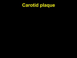 Carotid plaque
 