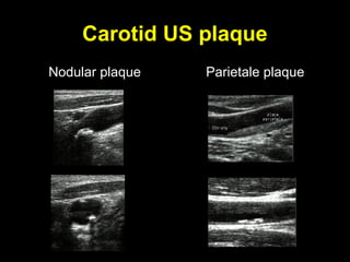 Carotid US plaque
Nodular plaque Parietale plaque
 