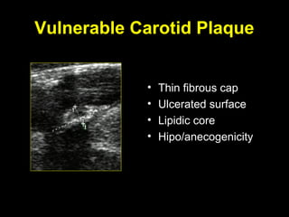 Vulnerable Carotid Plaque
• Thin fibrous cap
• Ulcerated surface
• Lipidic core
• Hipo/anecogenicity
 