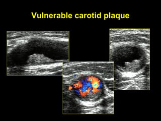 Vulnerable carotid plaque
 