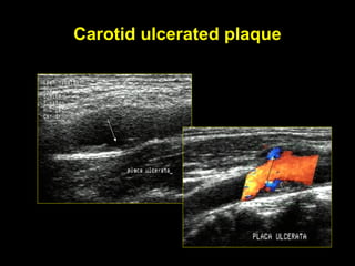 Carotid ulcerated plaque
 