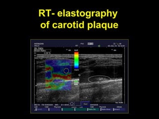 RT- elastography
of carotid plaque
 