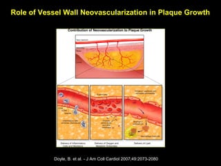 Doyle, B. et al. - J Am Coll Cardiol 2007;49:2073-2080
Role of Vessel Wall Neovascularization in Plaque Growth
 