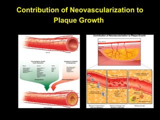 Contribution of Neovascularization to
Plaque Growth
 