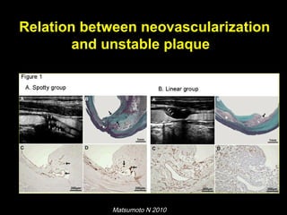 Relation between neovascularization
and unstable plaque
Matsumoto N 2010
 