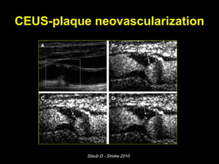 CEUS-plaque neovascularization
Staub D - Stroke 2010
 