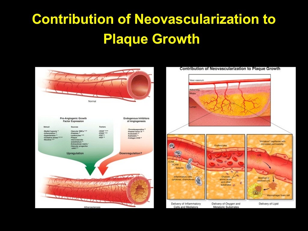 High dose statins in plaque stabilization