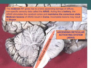 RETICULAR
FORMATION
ASCENDING RETICULAR
ACTIVATING SYSTEM
(ARAS)
The midbrain RF gives rise to a tonic ascending barrage of diffuse,
non­specific sensory data called the ARAS. Acting like a battery, the
ARAS stimulates the cerebral cortex and maintains the conscious state.
Midbrain lesions of ARAS result in Coma. Incomplete lesions may result
in Stupor.
 