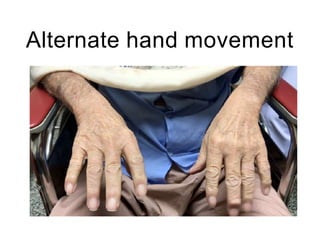 Alternate hand movement
 