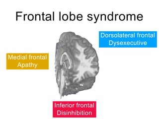 Frontal lobe syndrome
Medial frontal
Apathy
Dorsolateral frontal
Dysexecutive
Inferior frontal
Disinhibition
 