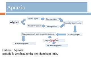 Apraxia
Callosal Apraxia:
apraxia is confined to the non-dominant limb, .
 