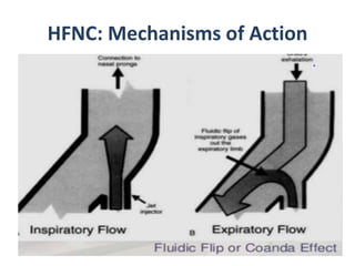 HFNC: Mechanisms of Action
• Reduces the resistance in inspiratory phase
created by nasopharengeal and oropharengeal
airway
• ?? Coanda effect during expiration which
facilitates expiratory effort reduction
 