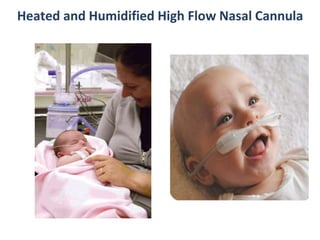 Heated and Humidified High Flow Nasal Cannula
 