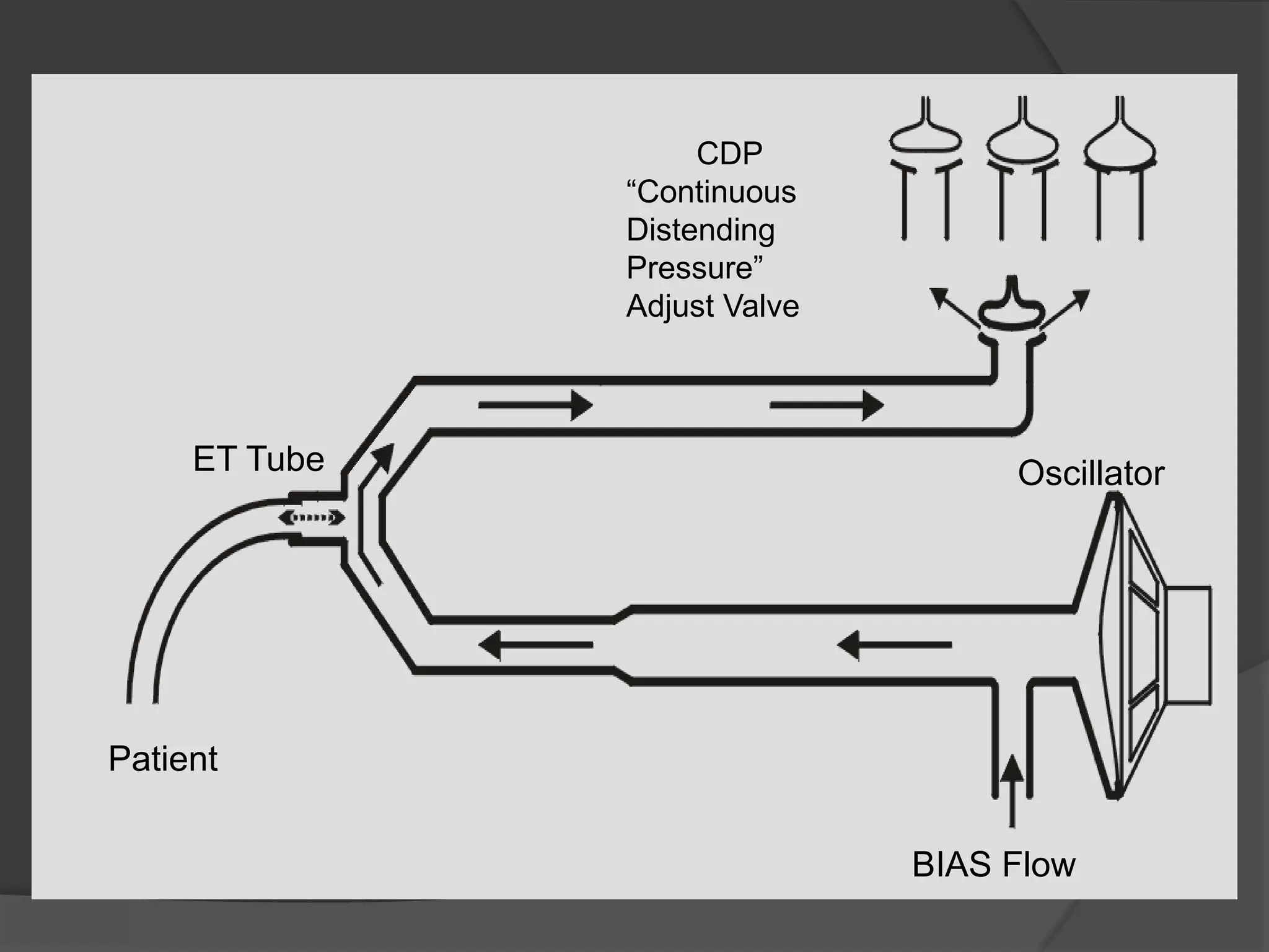 CDP“Continuous DistendingPressure”Adjust Valve   ET TubeOscillatorPatientBIAS Flow