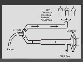 CDP“Continuous DistendingPressure”Adjust Valve   ET TubeOscillatorPatientBIAS Flow