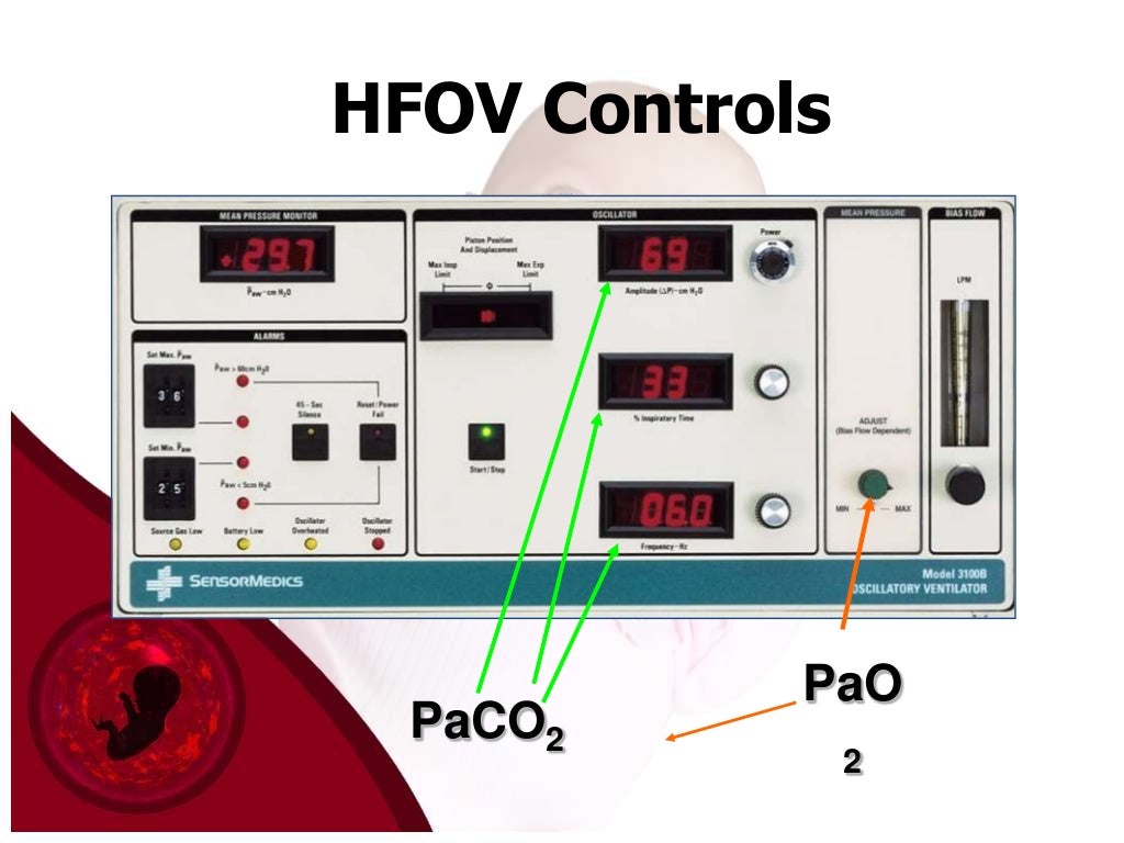 High frequency oscillatory ventilation