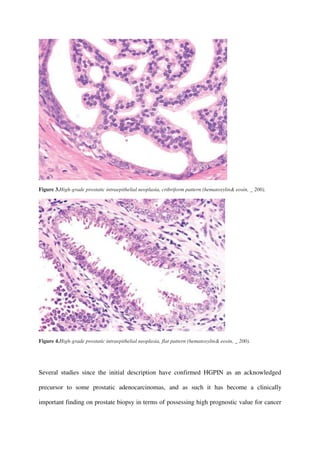 Figure 3.High-grade prostatic intraepithelial neoplasia, cribriform pattern (hematoxylin& eosin, _ 200).
Figure 4.High-grade prostatic intraepithelial neoplasia, flat pattern (hematoxylin& eosin, _ 200).
Several studies since the initial description have confirmed HGPIN as an acknowledged
precursor to some prostatic adenocarcinomas, and as such it has become a clinically
important finding on prostate biopsy in terms of possessing high prognostic value for cancer
 