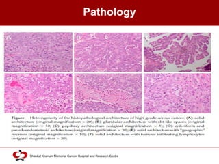 High Grade Serous Ovarian Cancer | PPTX