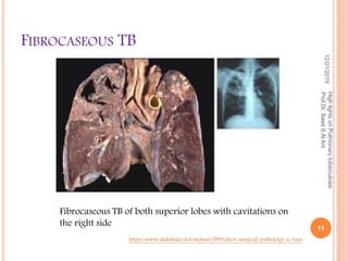 FIBROCASEOUS TB
12/01/2019
11
HighlightsonPulmonarytuberculosis
Prof.Dr.SaadSAlAni
https://www.slideshare.net/mohaa1989/chest-surgical-pathology-x-rays
Fibrocaseous TB of both superior lobes with cavitations on
the right side
 