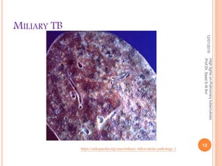 MILIARY TB
12/01/2019
12
HighlightsonPulmonarytuberculosis
Prof.Dr.SaadSAlAni
https://radiopaedia.org/cases/miliary-tuberculosis-pathology-1
 