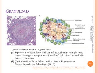 GRANULOMA
12/01/2019
13
HighlightsonPulmonarytuberculosis
Prof.Dr.SaadSAlAni
https://www.researchgate.net/figure/Typical-architecture-of-a-TB-granuloma
Typical architecture of a TB granuloma.
(A) Representative granuloma with central necrosis from mini pig lung
tissue. Histological samples were formalin-fixed cut and stained with
hematoxylin-eosin.
(B) (B) Schematic of the cellular constituents of a TB granuloma.
Source: Guirado and Schlesinger (2013).
 