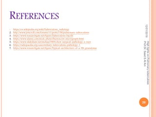 REFERENCES
12/01/2019
HighlightsonPulmonarytuberculosis
Prof.Dr.SaadSAlAni
20
1. https://en.wikipedia.org/wiki/Tuberculosis_radiology
2. http://www.jotscroll.com/forums/11/posts/158/pulmonary-tuberculosis
3. https://www.researchgate.net/figure/Tuberculous-bacilli
4. https://www.alamy.com/stock-photo/fluorescent-micrograph.html
5. https://www.slideshare.net/mohaa1989/chest-surgical-pathology-x-rays
6. https://radiopaedia.org/cases/miliary-tuberculosis-pathology-1
7. https://www.researchgate.net/figure/Typical-architecture-of-a-TB-granuloma
 