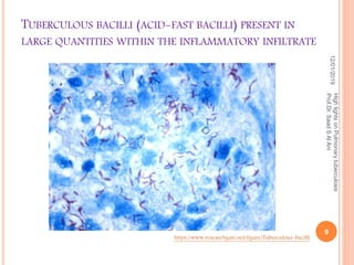 TUBERCULOUS BACILLI (ACID-FAST BACILLI) PRESENT IN
LARGE QUANTITIES WITHIN THE INFLAMMATORY INFILTRATE
12/01/2019
9
HighlightsonPulmonarytuberculosis
Prof.Dr.SaadSAlAni
https://www.researchgate.net/figure/Tuberculous-bacilli
 