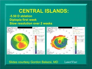 CENTRAL ISLANDS:
-5.50 D ablation
Diplopia first week
Slow resolution over 2 weeks




Slides courtesy Gordon Balazsi, MD
                                            ©DZ Reinstein 2009
                                     dzr@londonvisionclinic.com
 