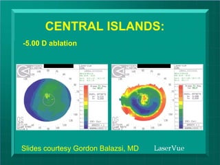CENTRAL ISLANDS:
-5.00 D ablation




Slides courtesy Gordon Balazsi, MD
                                            ©DZ Reinstein 2009
                                     dzr@londonvisionclinic.com
 