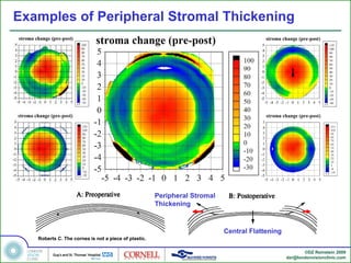 Examples of Peripheral Stromal Thickening




                                                      Peripheral Stromal
                                                      Thickening



                                                                           Central Flattening
   Roberts C. The cornea is not a piece of plastic.

                                                                                                       ©DZ Reinstein 2009
                                                                                                dzr@londonvisionclinic.com
 