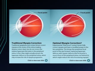 High myopia and management | PPTX