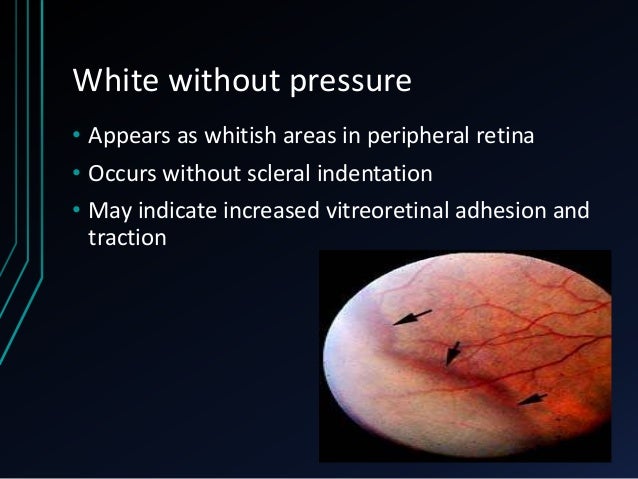 High Myopia And Management High Myopia And Management