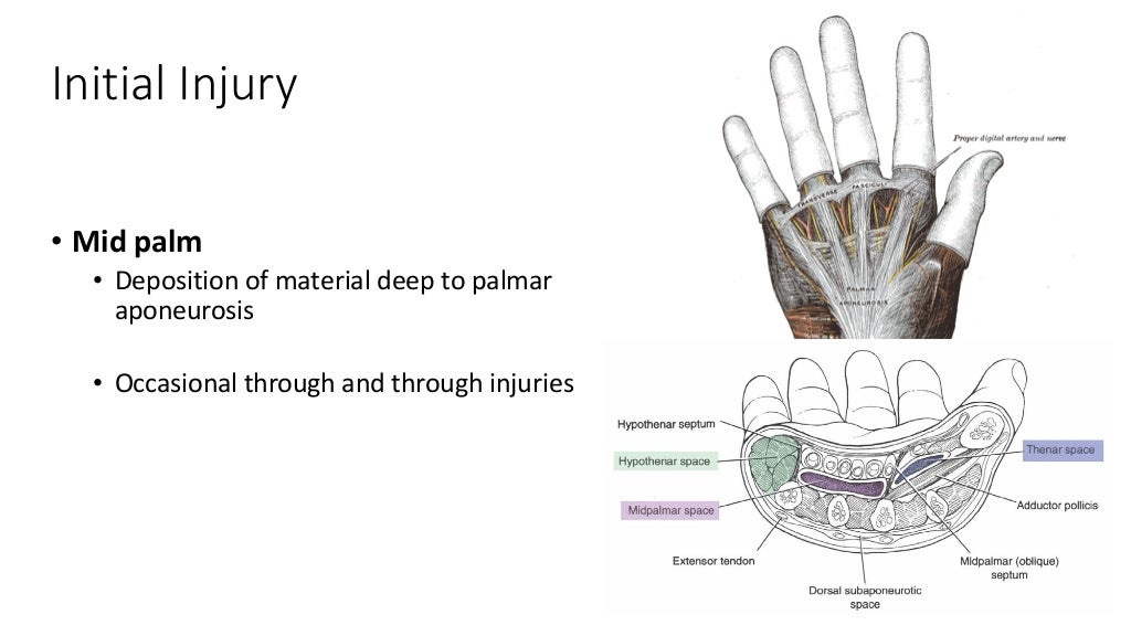 High pressure injection injuries Dr Sean Nicklin