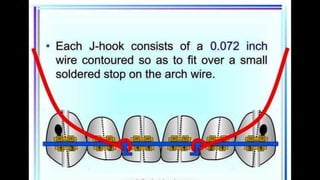 HIGH PULL HEADGEAR.pptx