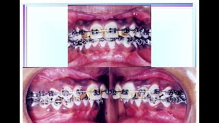 HIGH PULL HEADGEAR.pptx