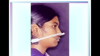 HIGH PULL HEADGEAR.pptx