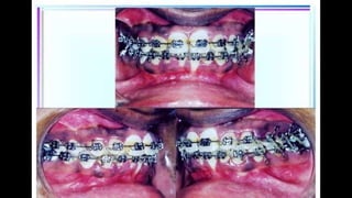 HIGH PULL HEADGEAR.pptx