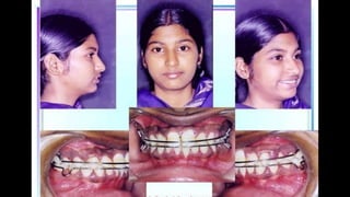 HIGH PULL HEADGEAR.pptx