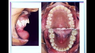 HIGH PULL HEADGEAR.pptx