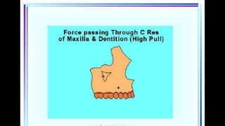 HIGH PULL HEADGEAR.pptx