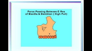 HIGH PULL HEADGEAR.pptx