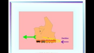 HIGH PULL HEADGEAR.pptx