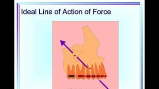 HIGH PULL HEADGEAR.pptx