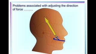 HIGH PULL HEADGEAR.pptx